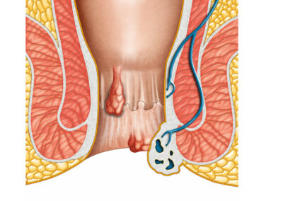 fissure doctor in Pune