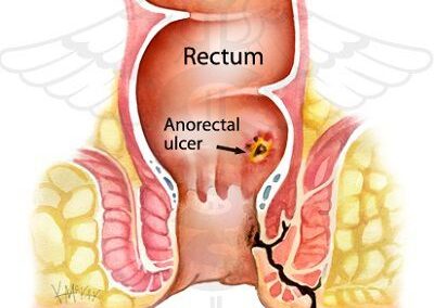 Best Fistula Treatment in Pune