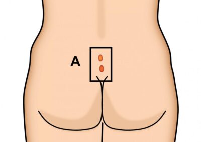 pilonidal sinus treatment in pune