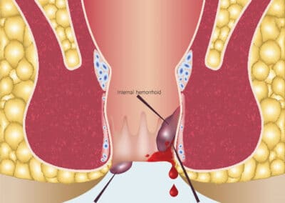 Piles Treatment In Pune